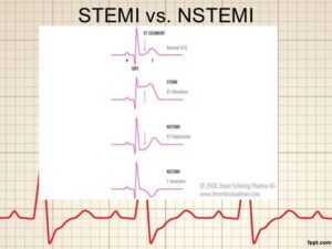 ECG and STEMI criteria - ECG-Excellence