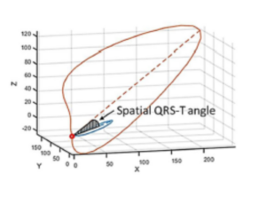 spatial QRS T angle image from article Nature communications