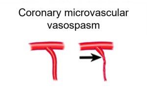 coronary microvascular vasospasm