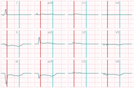 CineECG delta wave anterior wall infarction