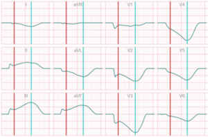 Inferior wall infarction; RCA distal of RV branch# delta map wave cineecg views