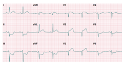 nterior wall heart infarction 4 x 3