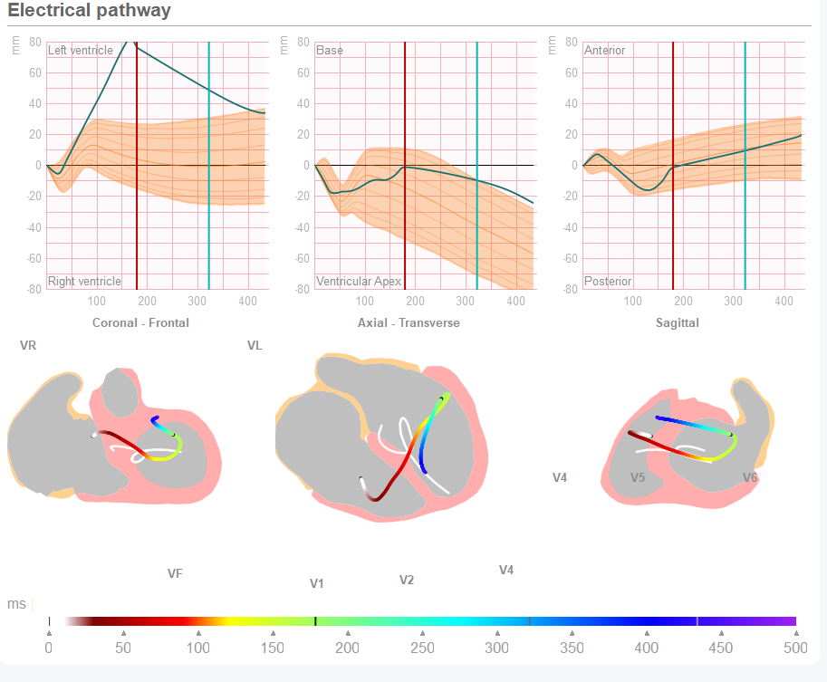 Male 70 yrs with Left Bundle Branche Block - ECG-Excellence